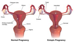 ectopic-pregnancy1