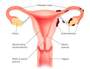 A méhtestrák tünetei, kezelése - Endometrium rák és endometriosis