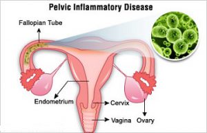 gyne-pain-pelvic-inflammatory-disease