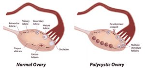 polycystic-ovarian-syndrome